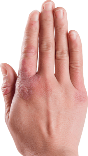 Hand with plaque psoriasis