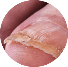 Close-up of nail psoriasis
