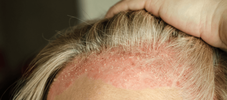 Irritation on scalp from plaque psoriasis