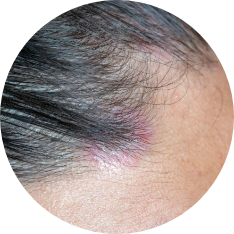 Scalp psoriasis on patient