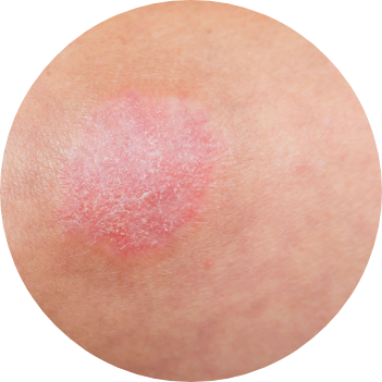 Plaque psoriasis on skin