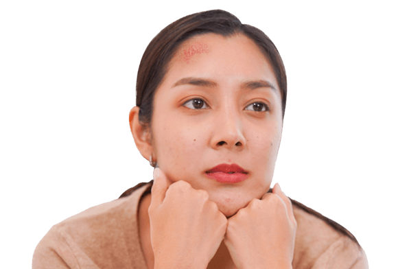 Catherine, hypothetical patient with plaque psoriasis