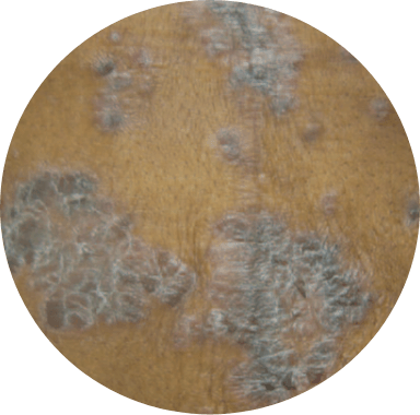 Thicker hyperkeratotic lesions on skin of color